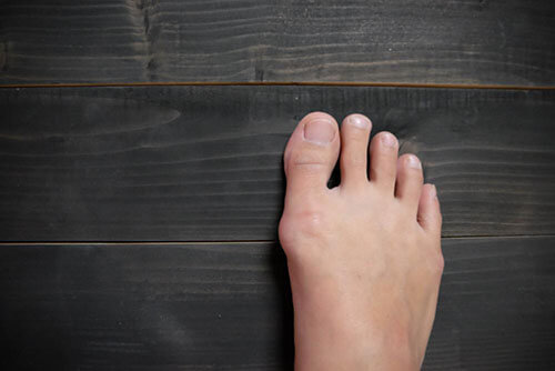 5 Steps For Minimizing Your Risk Of Gout